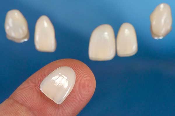 Porcelain veneers