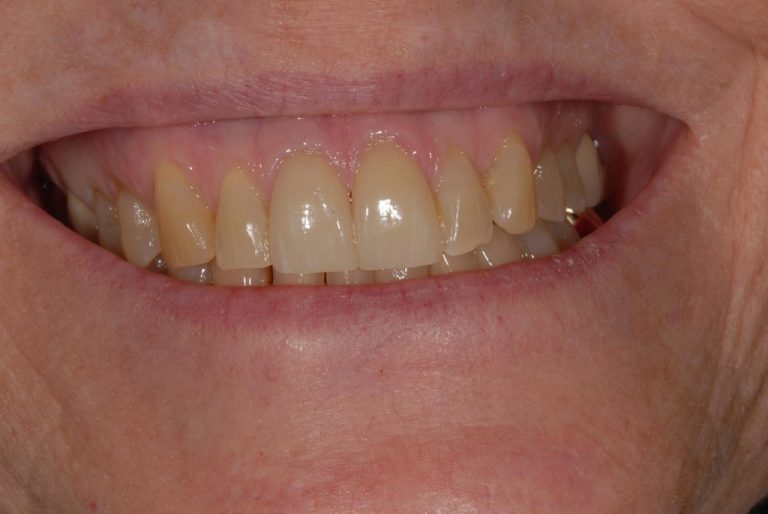 Detecting Decay Under Dental Crowns Rancho Palos Verdes, CA