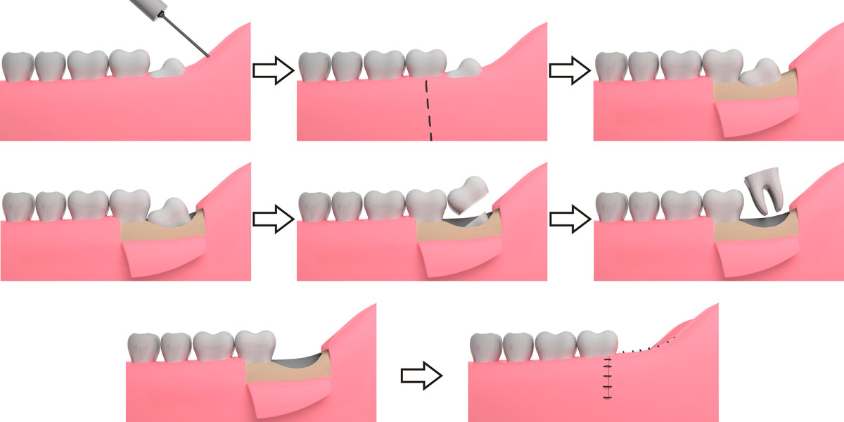 Invisalign® clear aligner